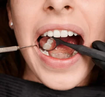 Why You Must Welcome Recommendation of Tooth Extraction?