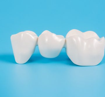 What are Dental Bridges: Types, Advantages & Aftercare Tips