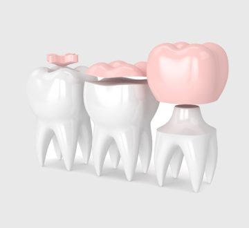 How to Care for Your Inlays & Onlays: Tips from a Billerica, MA Dentist